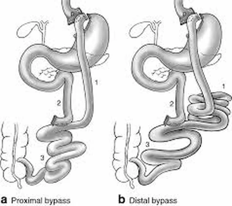 Distal bypass: a kiiktatott bélszakasz meghosszabbítása