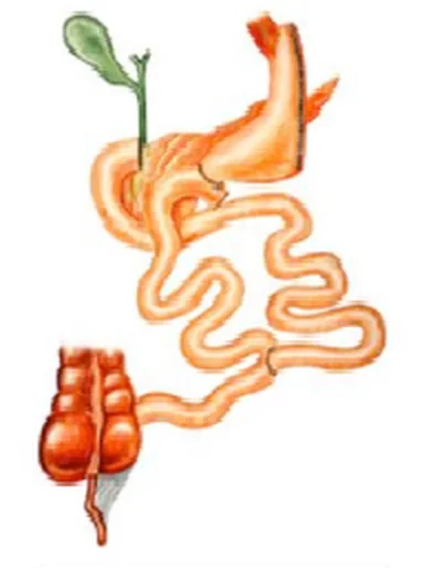 A duodenal switch műtét sémája