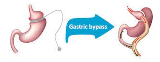 A gyomorgyűrű–bypass átalakítás sémája
