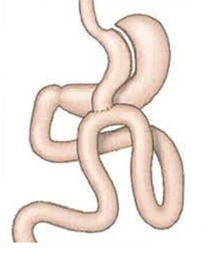 A mini (omega loop) bypass sémája