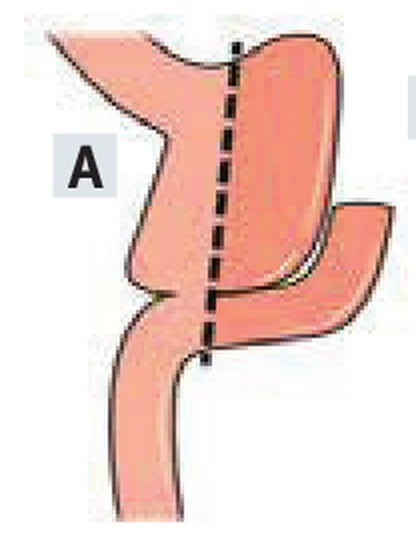 Pouch resizing: a gyomortasak megkisebbítése